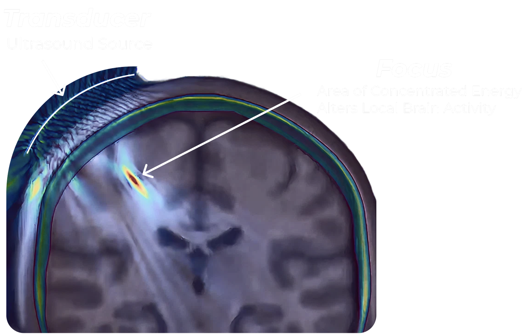Transcranial focused ultrasound diagram